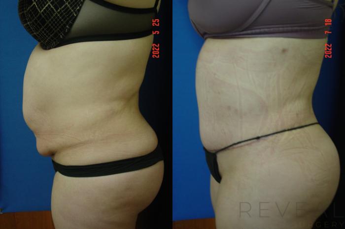 Before & After Liposuction Case 683 Right Side View in San Jose, CA