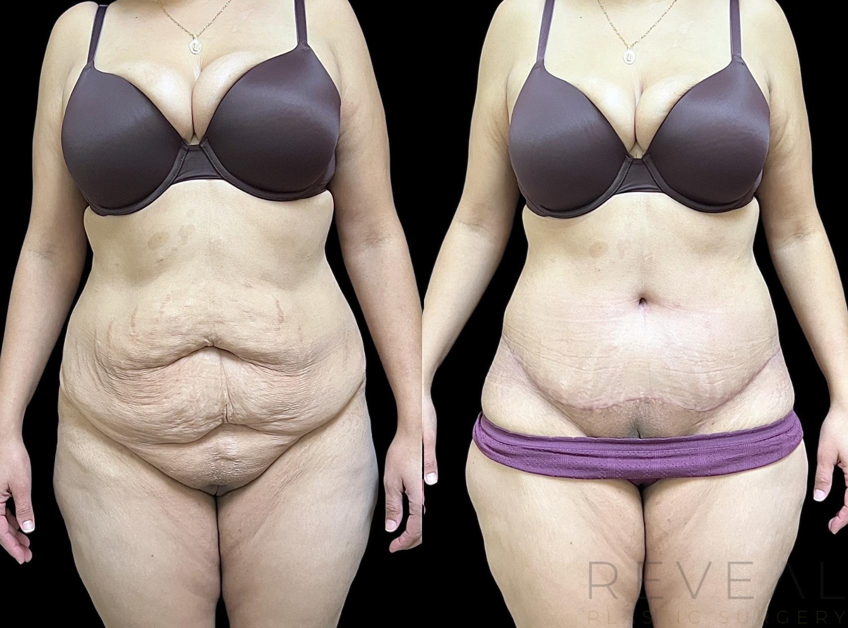 Before & After Liposuction Case 692 Front View in San Jose, CA