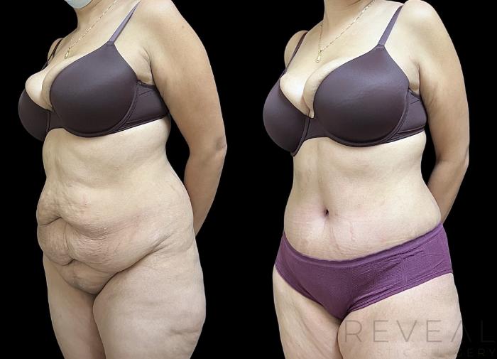 Before & After Tummy Tuck Case 692 Right Oblique View in San Jose, CA