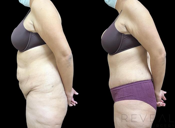 Before & After Tummy Tuck Case 692 Right Side View in San Jose, CA