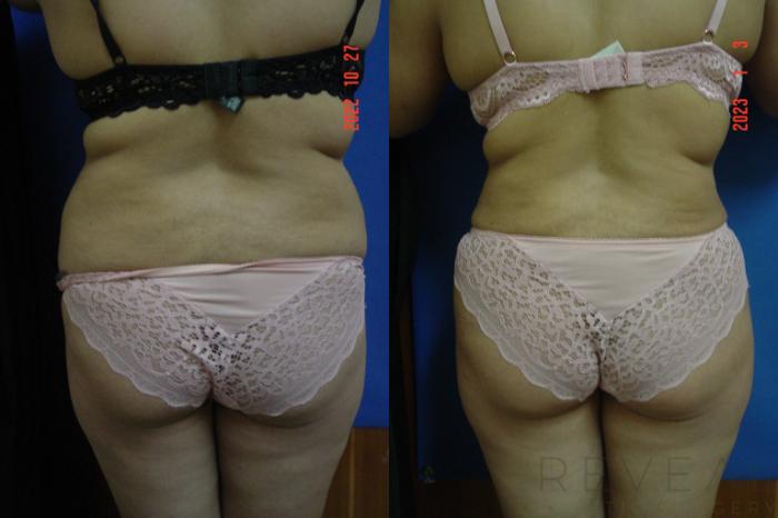 Before & After Liposuction Case 696 Back View in San Jose, CA