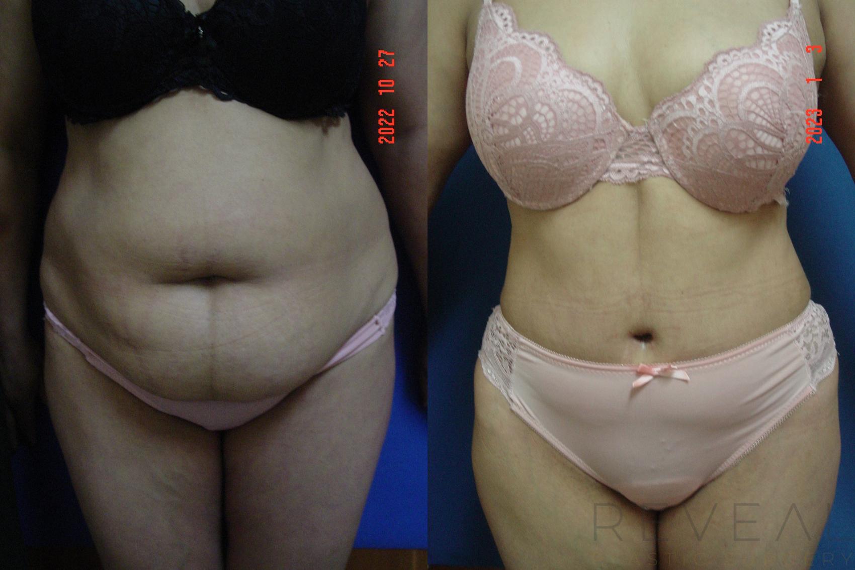 Before & After Liposuction Case 696 Front View in San Jose, CA