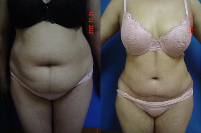 Before & After Liposuction Case 696 Front with scar View in San Jose, CA
