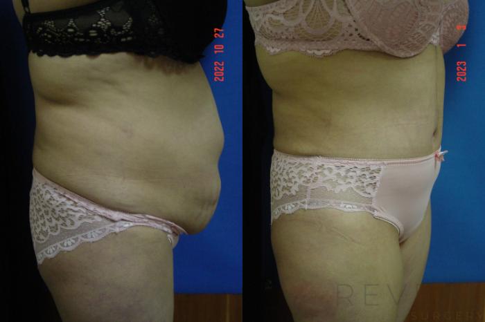 Before & After Tummy Tuck Case 696 Left Side View in San Jose, CA