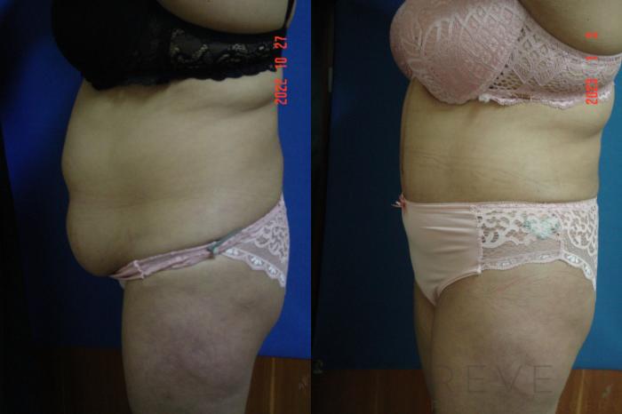 Before & After Liposuction Case 696 Right Side View in San Jose, CA