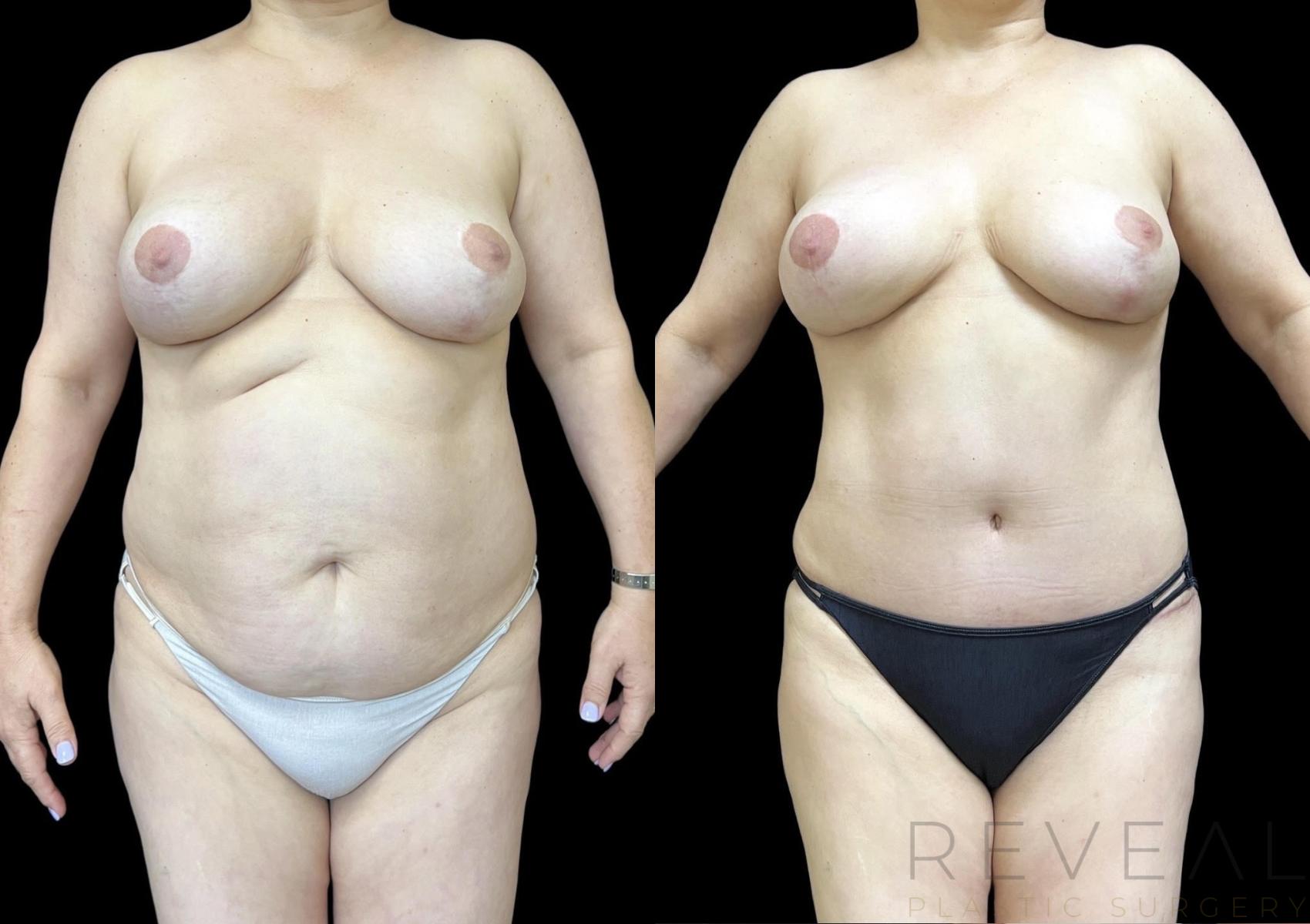 Before & After Tummy Tuck Case 698 Front View in San Jose, CA