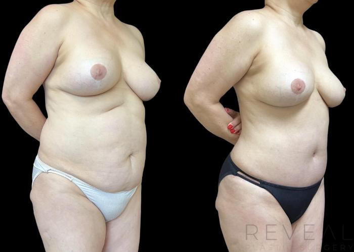 Before & After Tummy Tuck Case 698 Left Side View in San Jose, CA