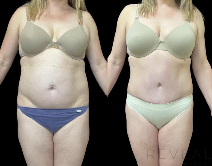 Before & After Tummy Tuck Case 708 Front View in San Jose, CA