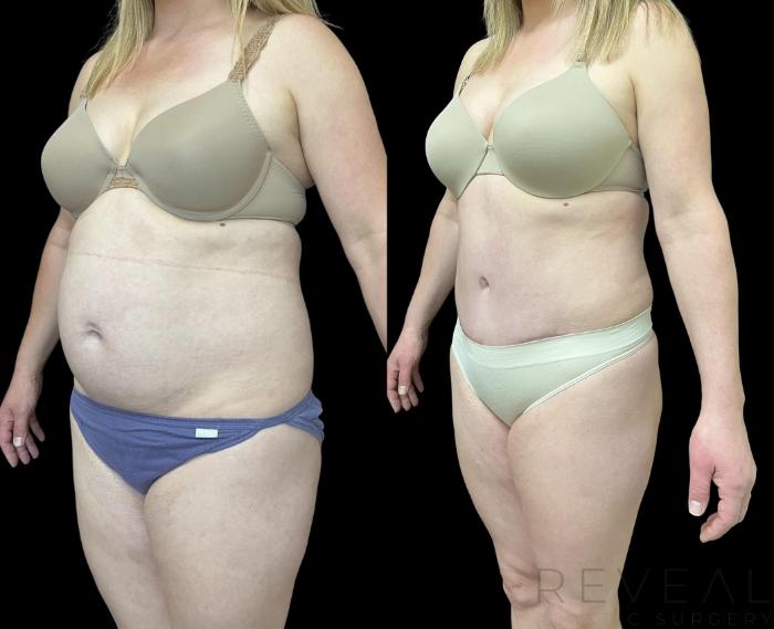 Before & After Liposuction Case 708 Left Oblique View in San Jose, CA