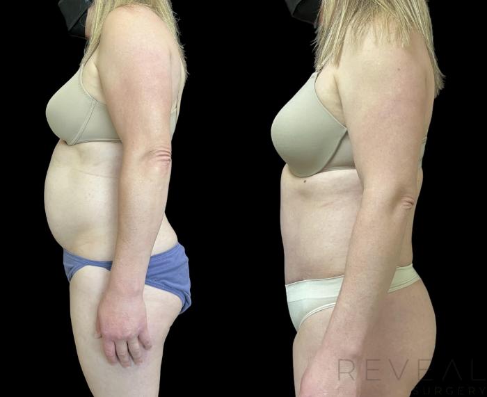 Before & After Liposuction Case 708 Left Side View in San Jose, CA