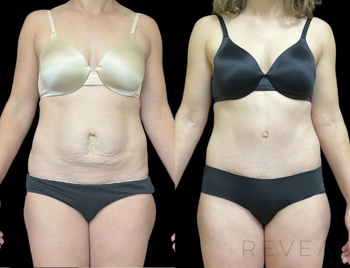 Before & After Tummy Tuck Case 715 Front View in San Jose, CA