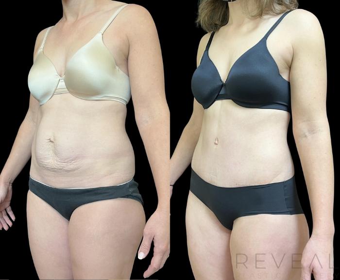 Before & After Tummy Tuck Case 715 Right Oblique View in San Jose, CA