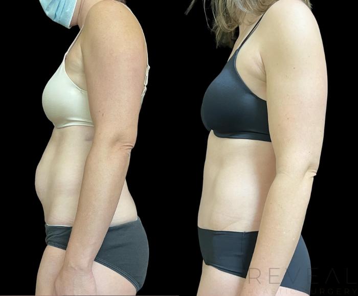 Before & After Tummy Tuck Case 715 Right Side View in San Jose, CA