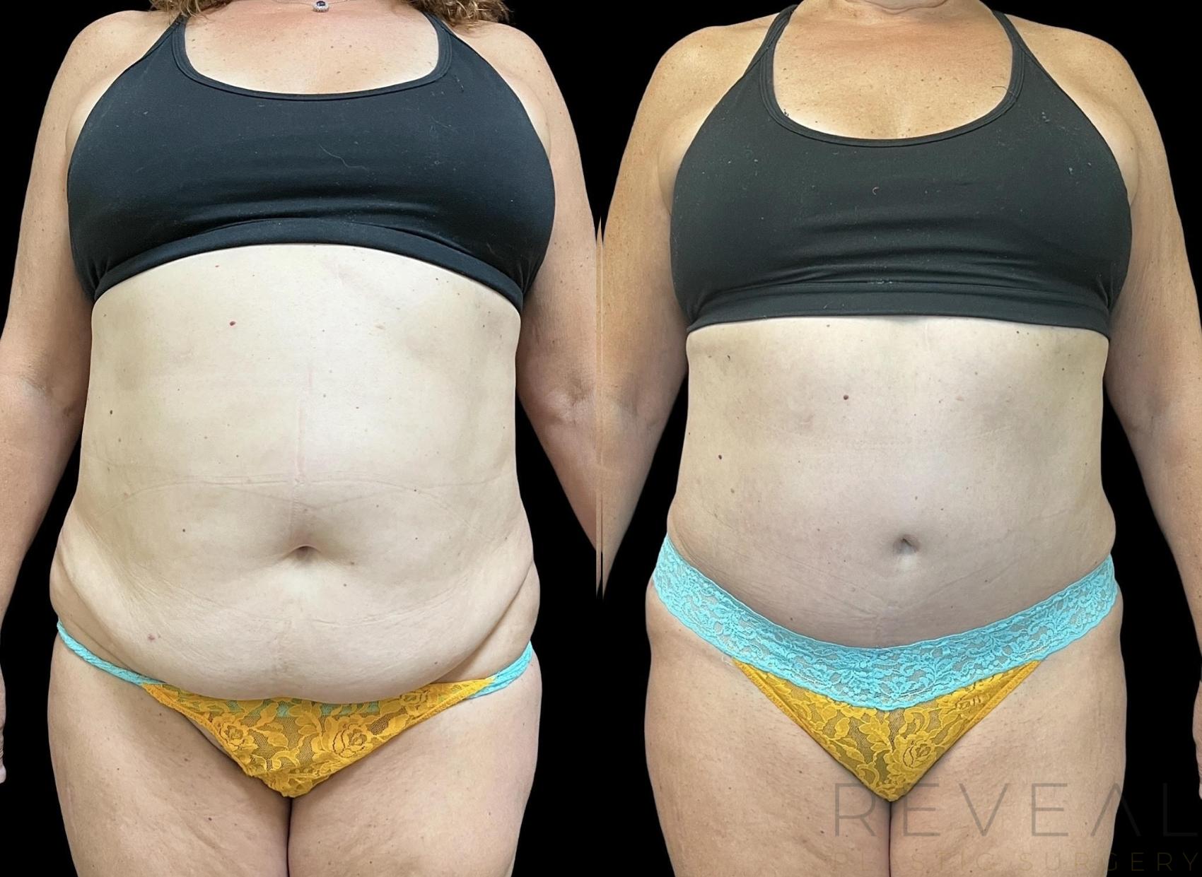Before & After Tummy Tuck Case 717 Front View in San Jose, CA