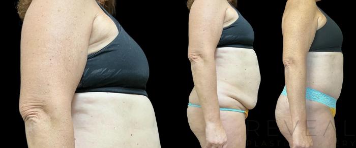 Before & After Tummy Tuck Case 717 Left Oblique View in San Jose, CA
