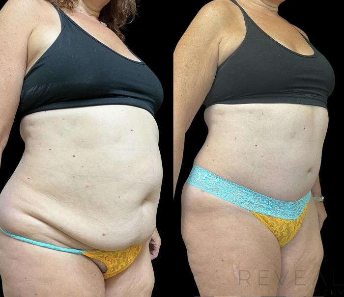 Before & After Tummy Tuck Case 717 Left Side View in San Jose, CA
