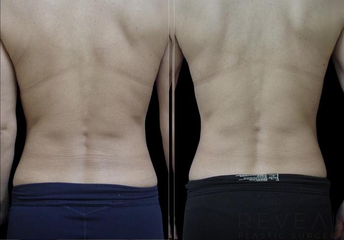 Before & After Liposuction Case 720 Back View in San Jose, CA