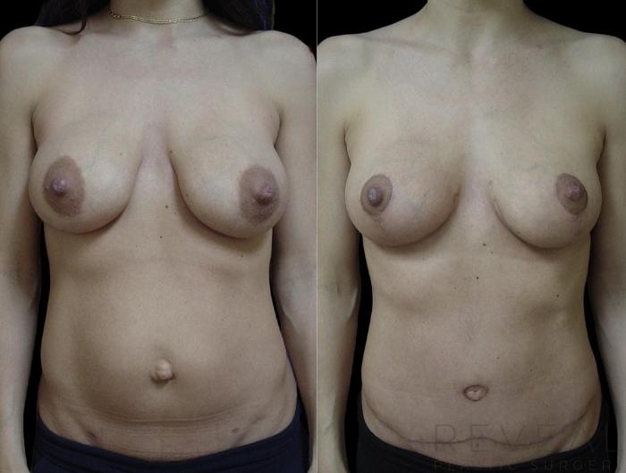 Before & After Tummy Tuck Case 720 Front View in San Jose, CA