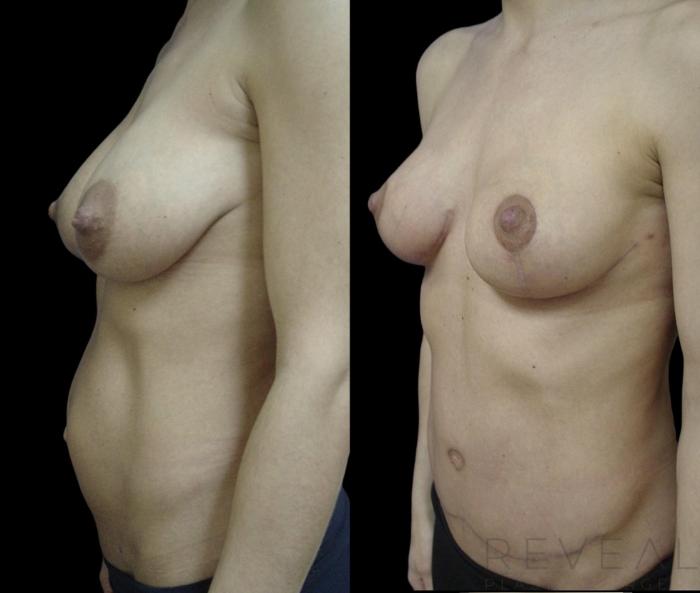 Before & After Liposuction Case 720 Left Side View in San Jose, CA