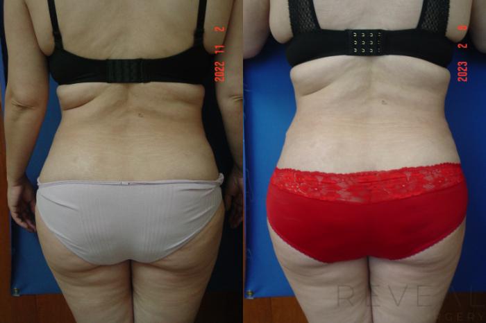 Before & After Liposuction Case 728 Back View in San Jose, CA