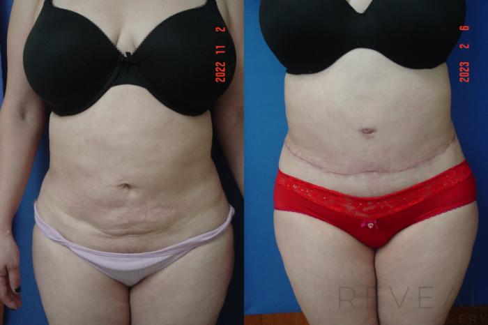 Before & After Tummy Tuck Case 728 Front View in San Jose, CA