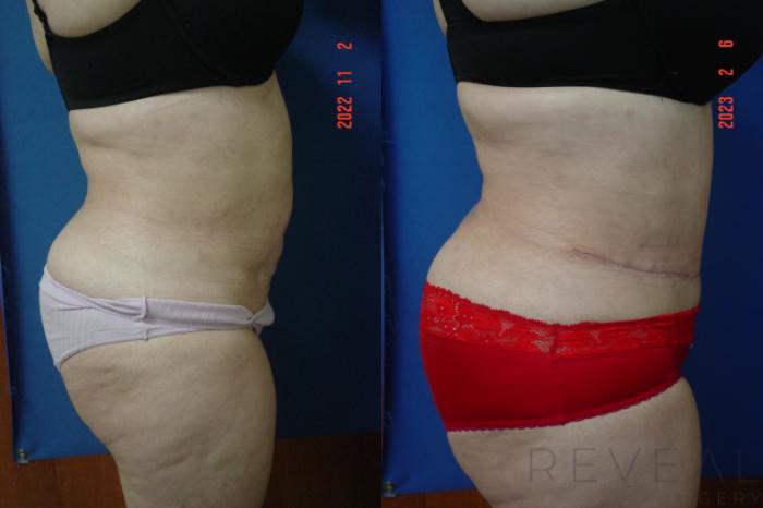 Before & After Tummy Tuck Case 728 Left Oblique View in San Jose, CA