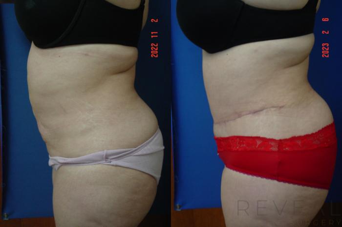 Before & After Liposuction Case 728 Left Side View in San Jose, CA