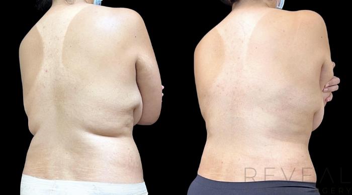 Before & After Tummy Tuck Case 734 Back View in San Jose, CA