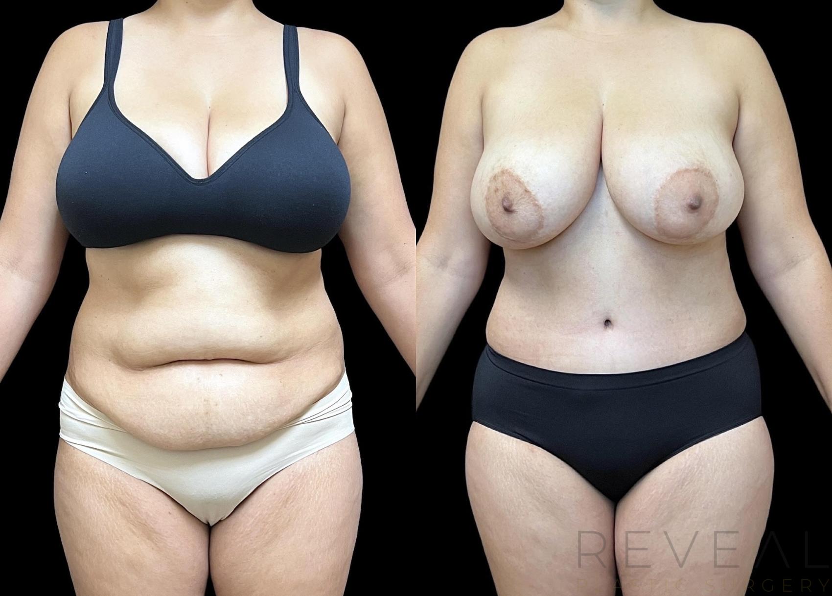 Before & After Tummy Tuck Case 734 Front View in San Jose, CA