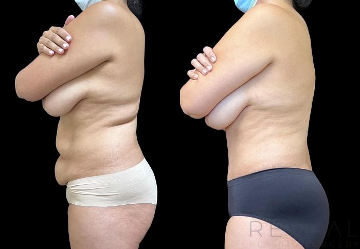Before & After Tummy Tuck Case 734 Left Oblique View in San Jose, CA