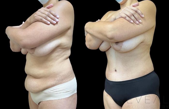 Before & After Tummy Tuck Case 734 Left Side View in San Jose, CA