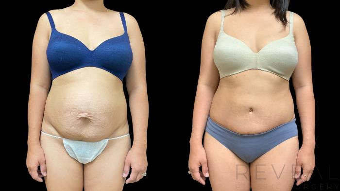 Before & After Liposuction Case 766 Front View in San Jose, CA
