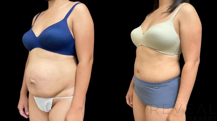 Before & After Liposuction Case 766 Left Oblique View in San Jose, CA