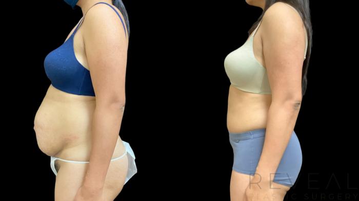 Before & After Tummy Tuck Case 766 Left Side View in San Jose, CA
