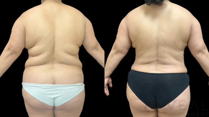Before & After Tummy Tuck Case 777 Back View in San Jose, CA
