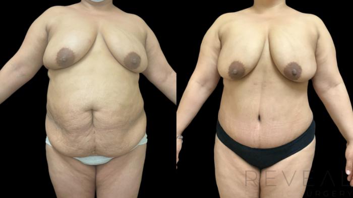 Before & After Tummy Tuck Case 777 Front View in San Jose, CA