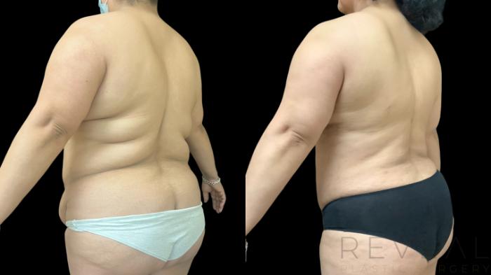 Before & After Tummy Tuck Case 777 Left Back Oblique View in San Jose, CA