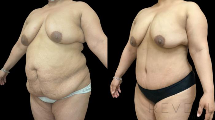 Before & After Tummy Tuck Case 777 Left Oblique View in San Jose, CA