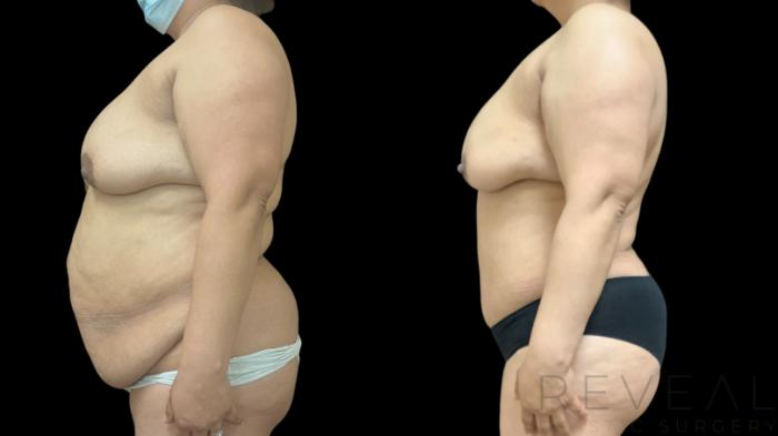 Before & After Tummy Tuck Case 777 Left Side View in San Jose, CA
