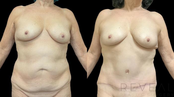 Before & After Tummy Tuck Case 778 Front View in San Jose, CA