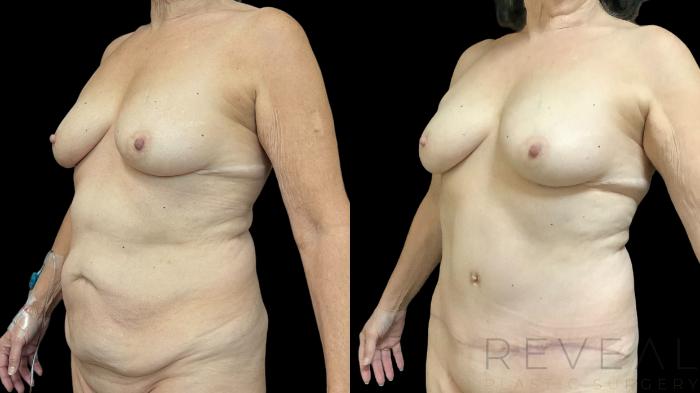 Before & After Tummy Tuck Case 778 Left Oblique View in San Jose, CA