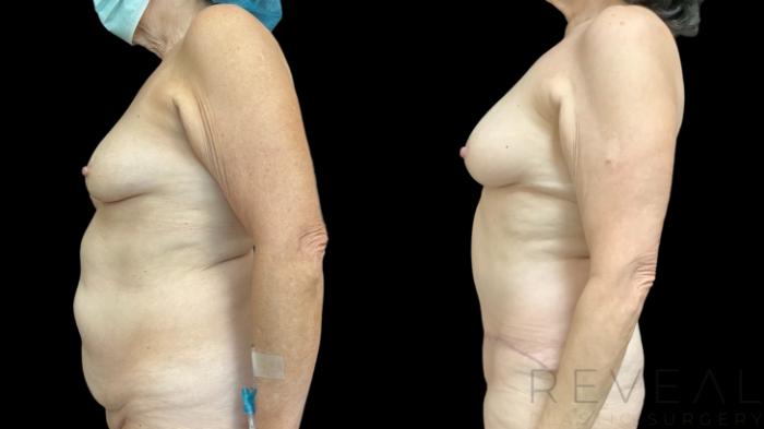 Before & After Tummy Tuck Case 778 Left Side View in San Jose, CA