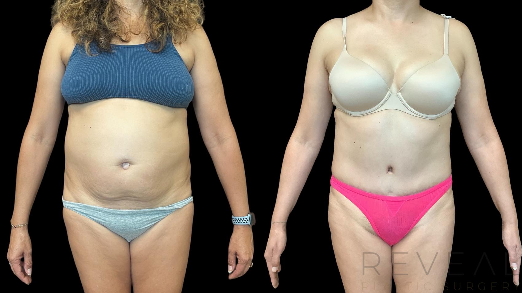 Before & After Tummy Tuck Case 783 Front View in San Jose, CA