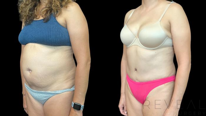 Before & After Tummy Tuck Case 783 Left Oblique View in San Jose, CA