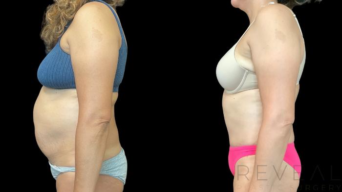 Before & After Tummy Tuck Case 783 Left Side View in San Jose, CA