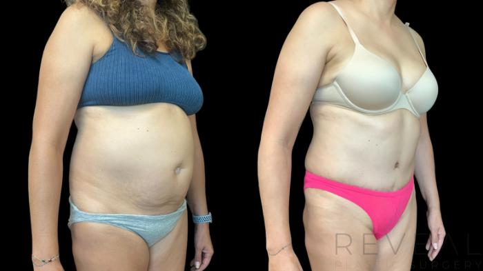 Before & After Tummy Tuck Case 783 Right Oblique View in San Jose, CA