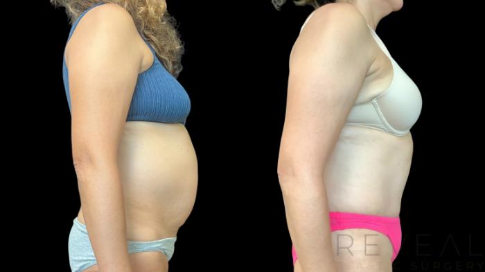 Before & After Tummy Tuck Case 783 Right Side View in San Jose, CA