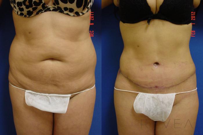 Before & After Tummy Tuck Case 84 View #1 View in San Jose, CA