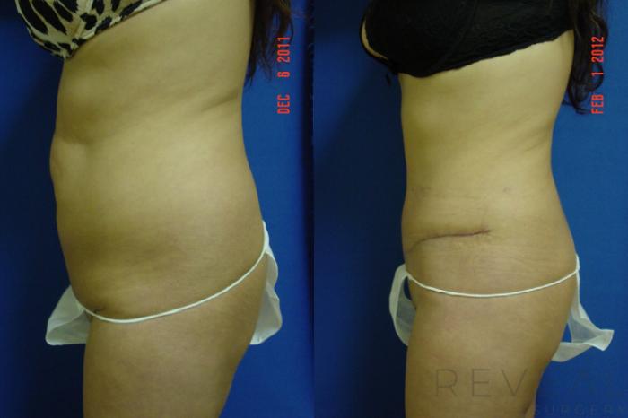 Before & After Liposuction Case 84 View #2 View in San Jose, CA