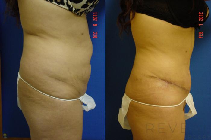 Before & After Liposuction Case 84 View #3 View in San Jose, CA
